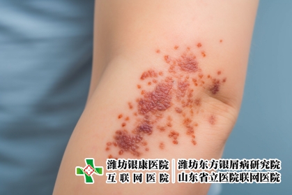 攝圖網(wǎng)_600370515_牛皮癬類型（企業(yè)商用）_副本