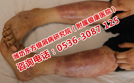治療牛皮癬理想的醫院