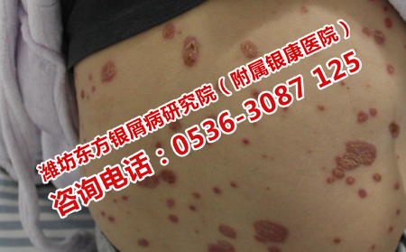 濰坊理想的銀屑病治療醫院
