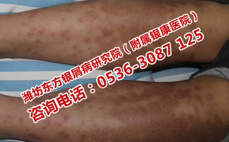 實現牛皮癬長期穩定的方法