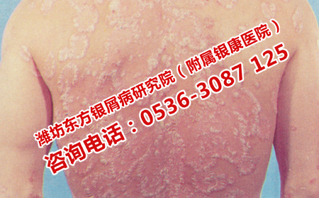 牛皮癬怎樣就治療效果理想了