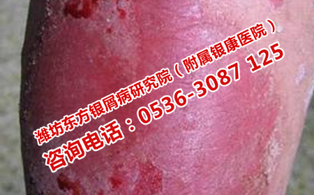 得了牛皮癬怎樣養(yǎng)生