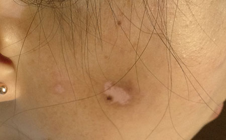 白癜風發病原因,女性白癜風