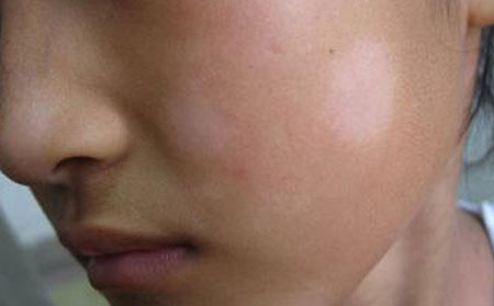 青少年白癜風的癥狀