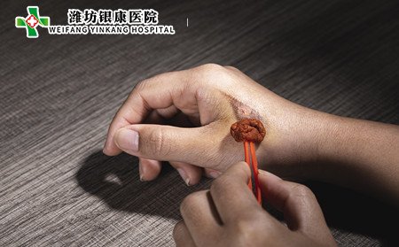 手部白癜風(fēng)治療,怎樣治手部白癜風(fēng)