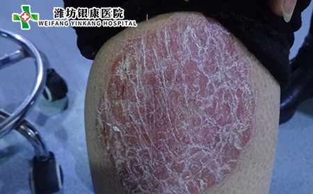 [山東]濰坊銀康醫(yī)院:成年人如何治療銀屑癬