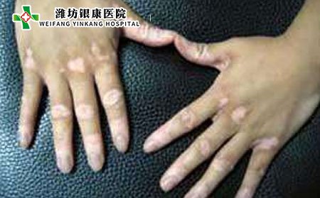 白癜風傳染嗎,白癜風會不會傳染