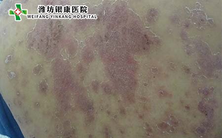 銀屑病癥狀,銀屑病有什么表現(xiàn)