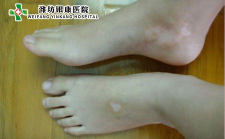 白癜風(fēng)病因,為什么會得白癜風(fēng)