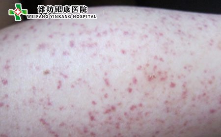 過敏性紫癜,嬰兒過敏性紫癜