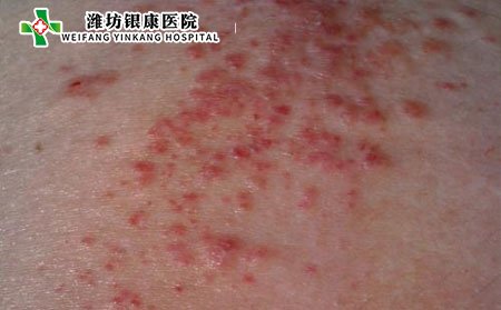 泛發(fā)性濕疹,泛發(fā)性濕疹傳染嗎