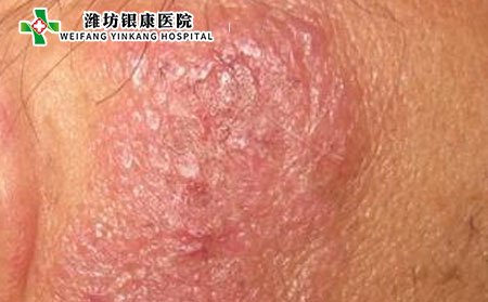 泛發性濕疹,泛發性濕疹癥狀,濕疹癥狀
