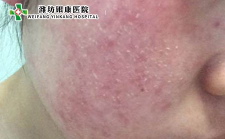 濰坊銀康醫(yī)院:中藥防治皮炎