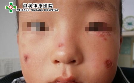 濰坊銀康醫院:中醫治療膿皰型銀屑病
