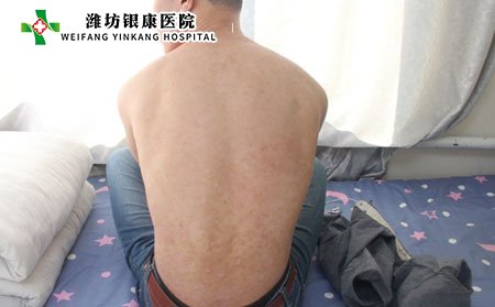 牛皮癬該如何預(yù)防?又該如何日常護(hù)理?
