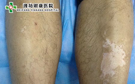 維生素C過量會引起白癜風嗎?