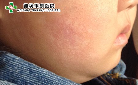 什么是血瘀型白癜風(fēng)?該如何護(hù)理?