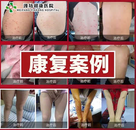 銀屑病皮膚病專家會診康復案例