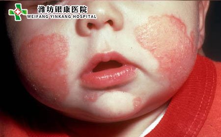 濰坊皮膚病醫院：預防嬰兒濕疹的措施